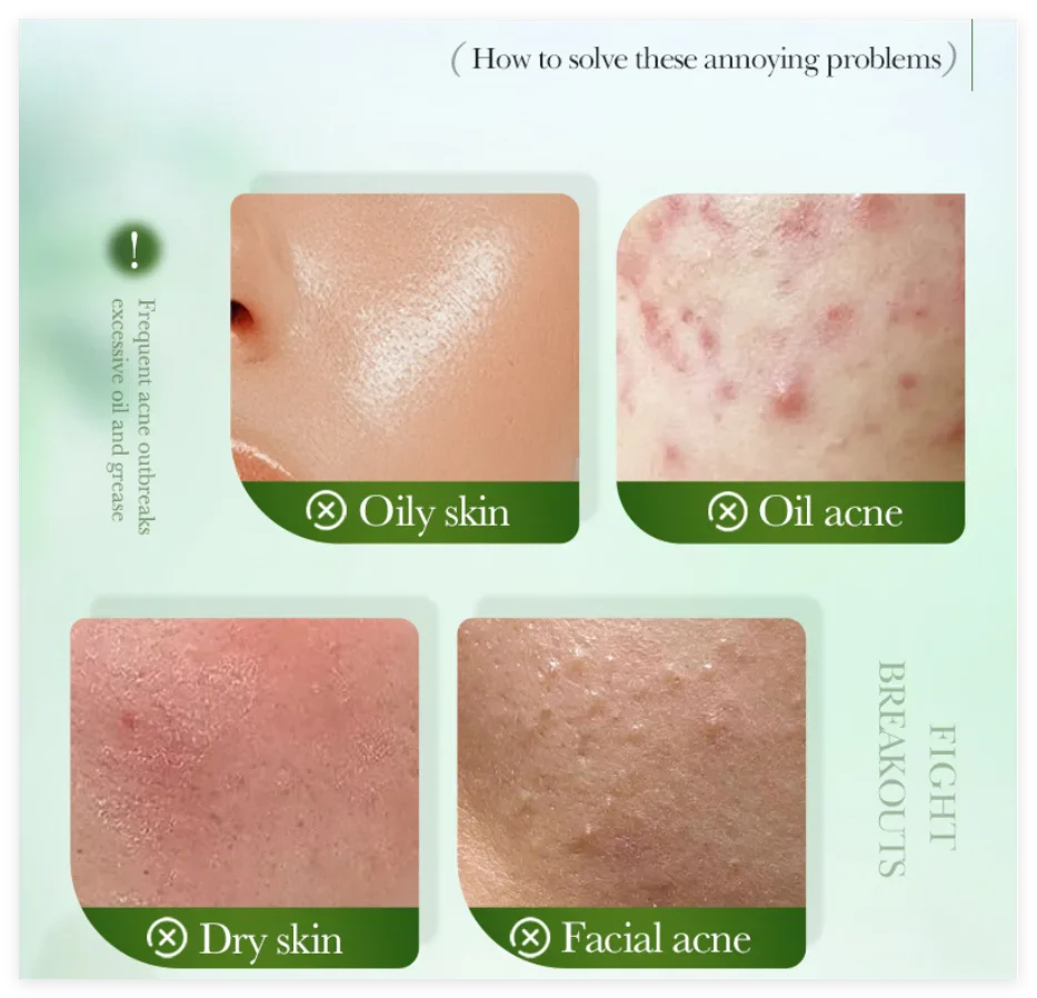 SADOER Salicylic Acid Face Cream – Oil Control & Clear Pores
