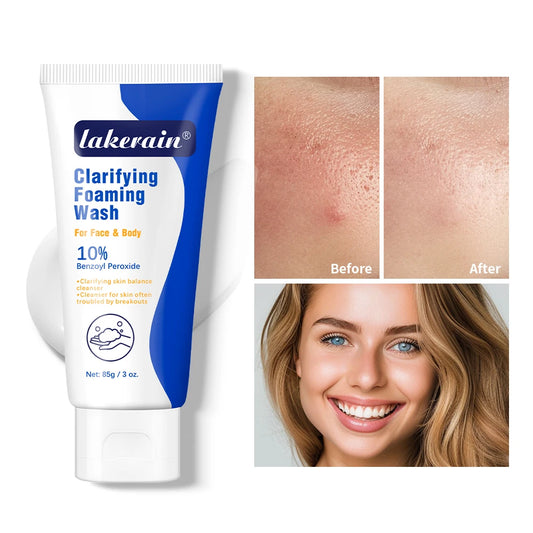 Acne Foaming Wash Benzoyl Peroxide 10% Maximum Antimicrobia Moisturizers reduces redness For Face & Body Skin Care Face Wash Peaceful Pleasures Health and Wellness 1pc