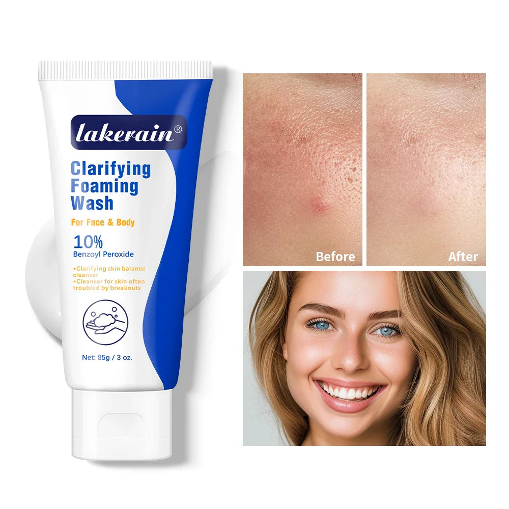 10% Benzoyl Peroxide Foaming Face & Body Wash | Oil Control