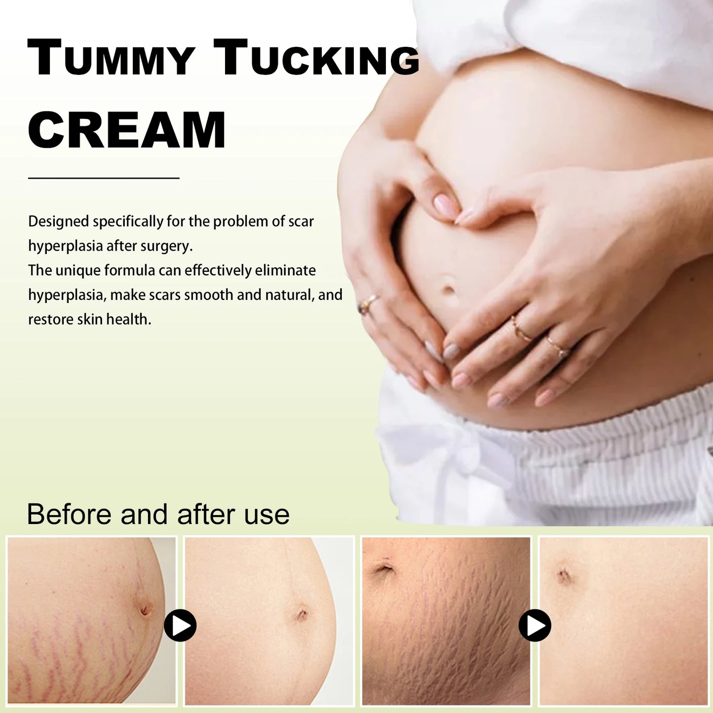 WIYUN Stretch Mark Cream – Firm, Repair & Smooth Skin 30g