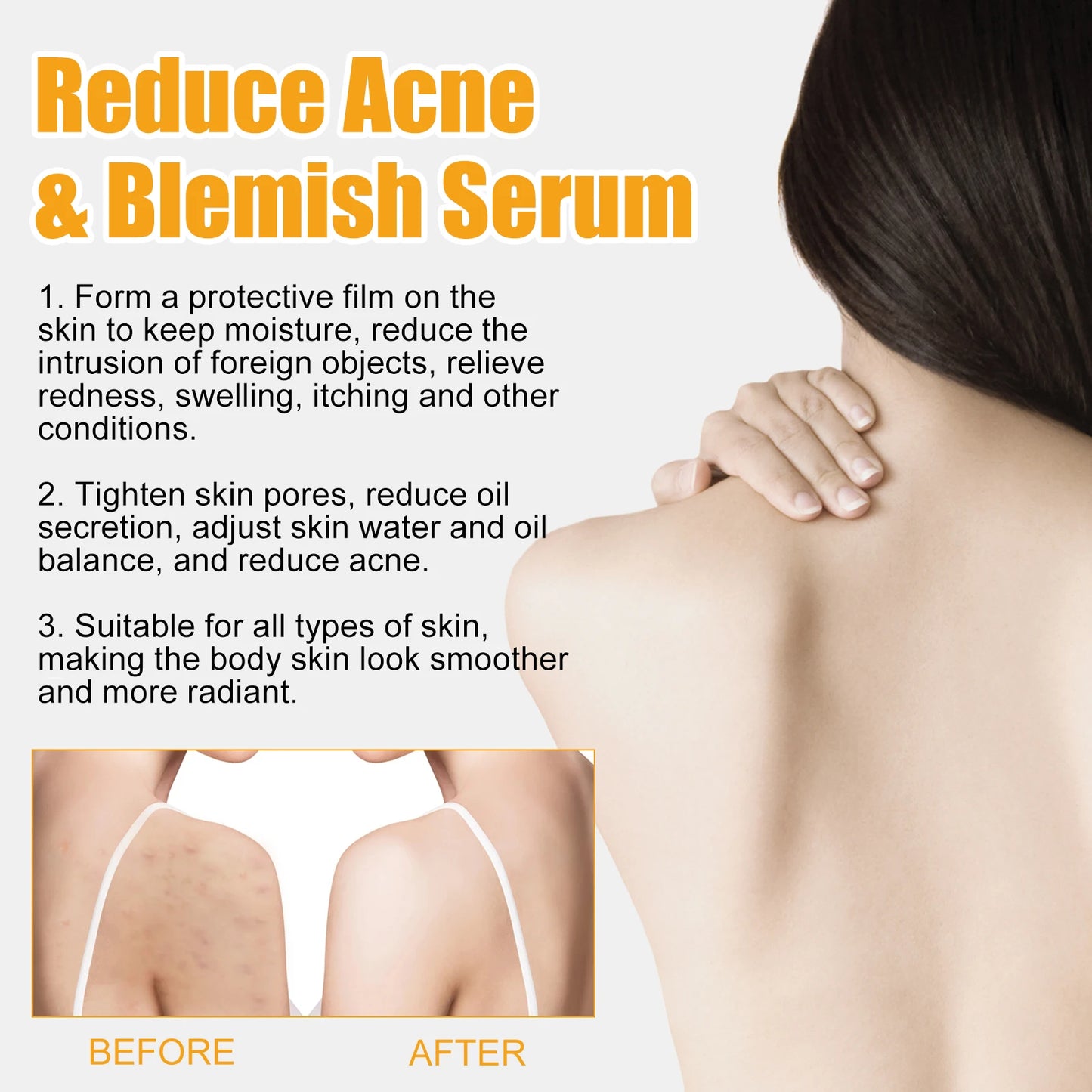 Jaysuing Acne Body Serum – Fade Spots & Moisturize Skin 50ml