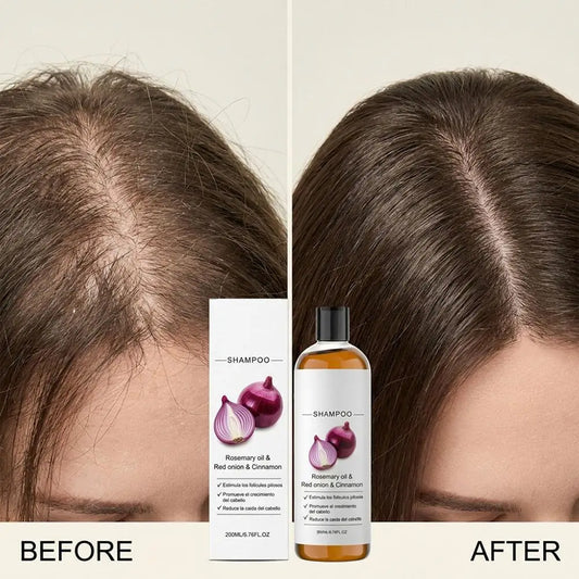 Rosemary Red Onion Shampoo Anti Hair Loss Promote Thicker Stronger excalvo Shampoo Hair Care 200ml Peaceful Pleasures Health and Wellness