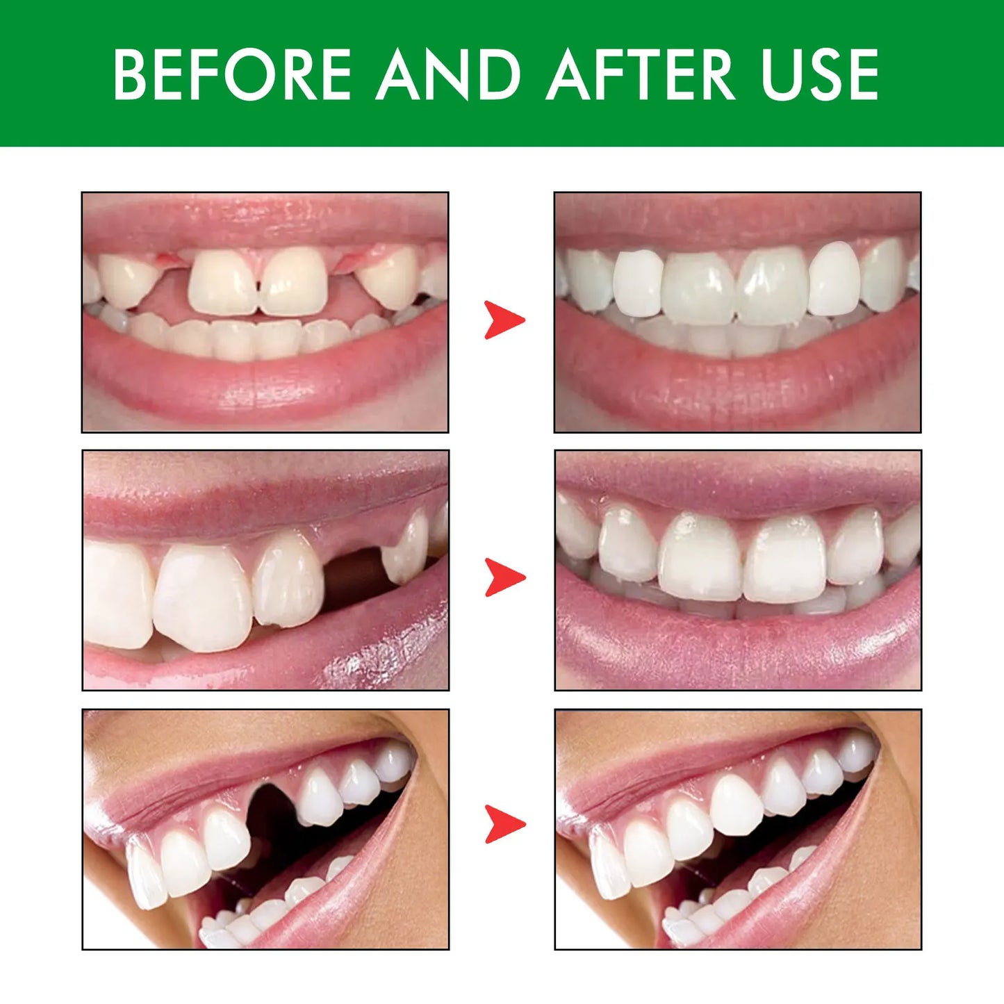 Moldable Temporary Tooth Kit – Gap Filler & Cosplay Teeth