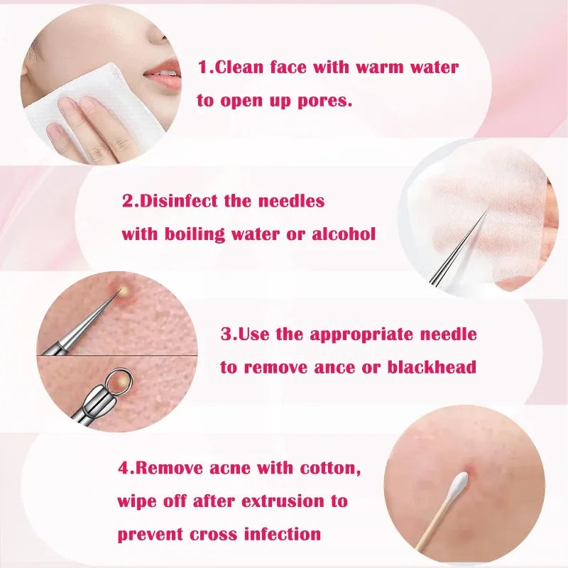 4-Pack Stainless Steel Blackhead & Comedone Extractor Kit