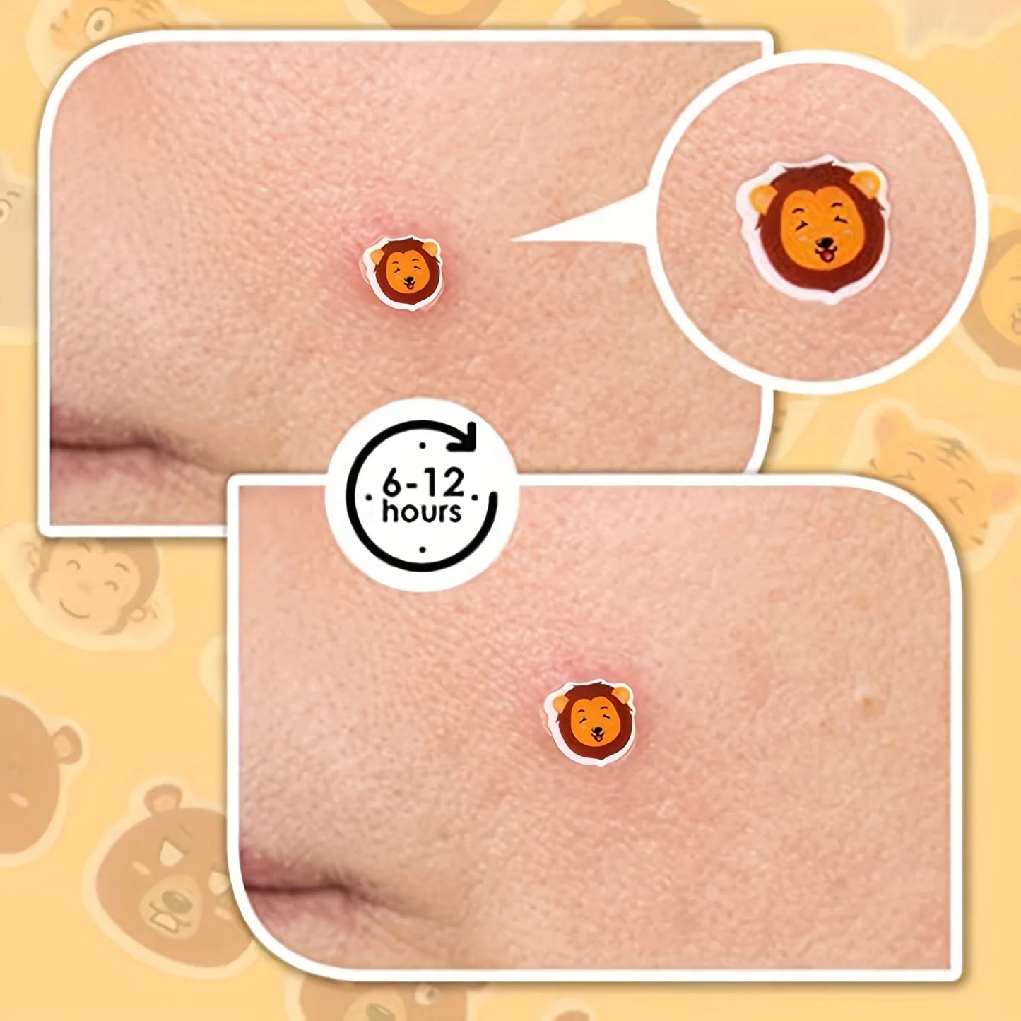 Hydrocolloid Acne Patches – Invisible, Waterproof, All Skin Types