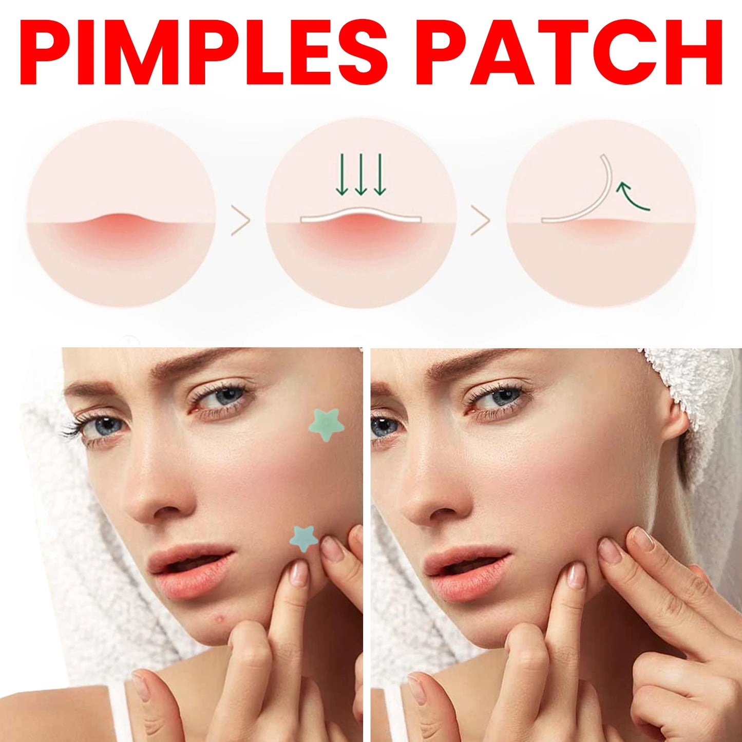 200-Pc Star Hydrocolloid Acne Pimple Patches – Fade Blemishes