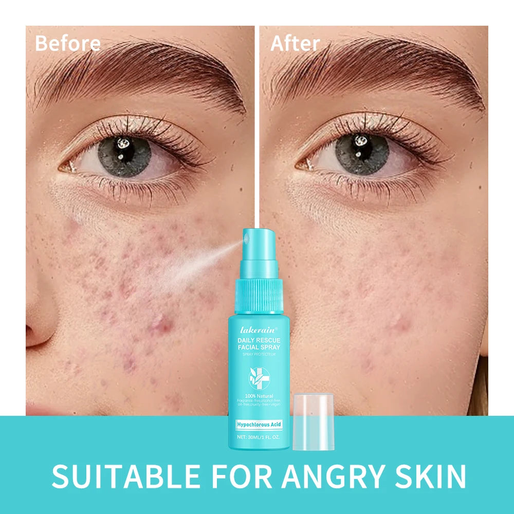 30ml Rescue Facial Spray For Sensitive Skin Hypochlorous Acid Spray Helps Reduce Redness Breakouts Soothing Balancing Spray Peaceful Pleasures Health and Wellness