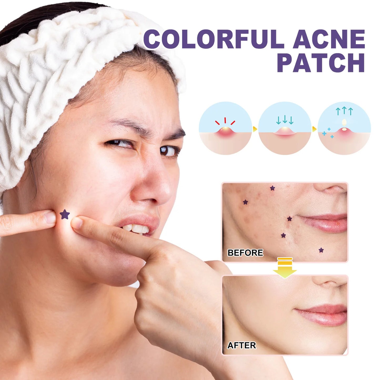 Acne Treatment Patch Absorbing Acne Cover Blemish Anti Infection Waterproof Spot Marks Concealer Colorful Pimple Removal Sticker Peaceful Pleasures Health and Wellness
