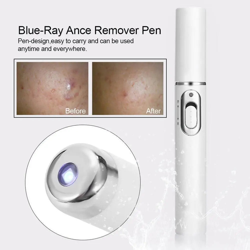 Skin Tag Removal Pen, Mole And Wart Removal Pen High-quality Anti Swelling Vessel Bulge Pain Blood Circulation Peaceful Pleasures Health and Wellness