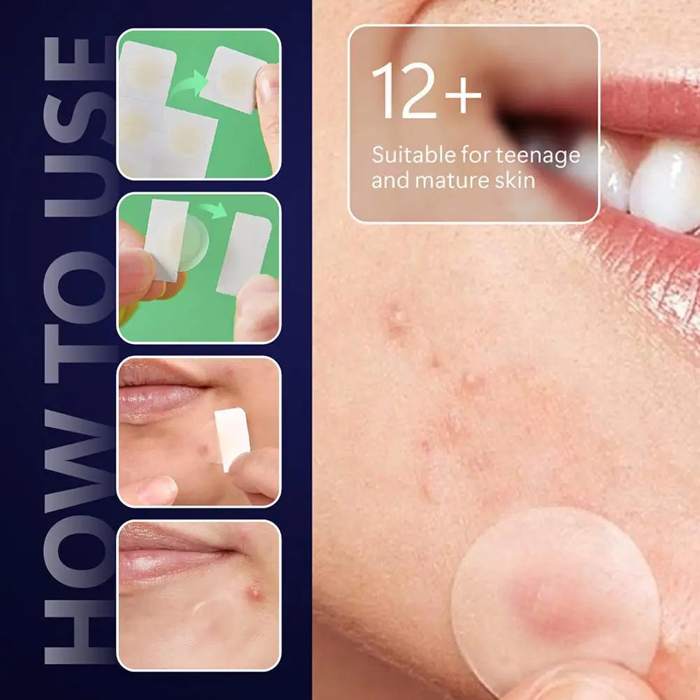 Microneedle Acne Patches 24PCS – Hydrocolloid Pimple Stickers