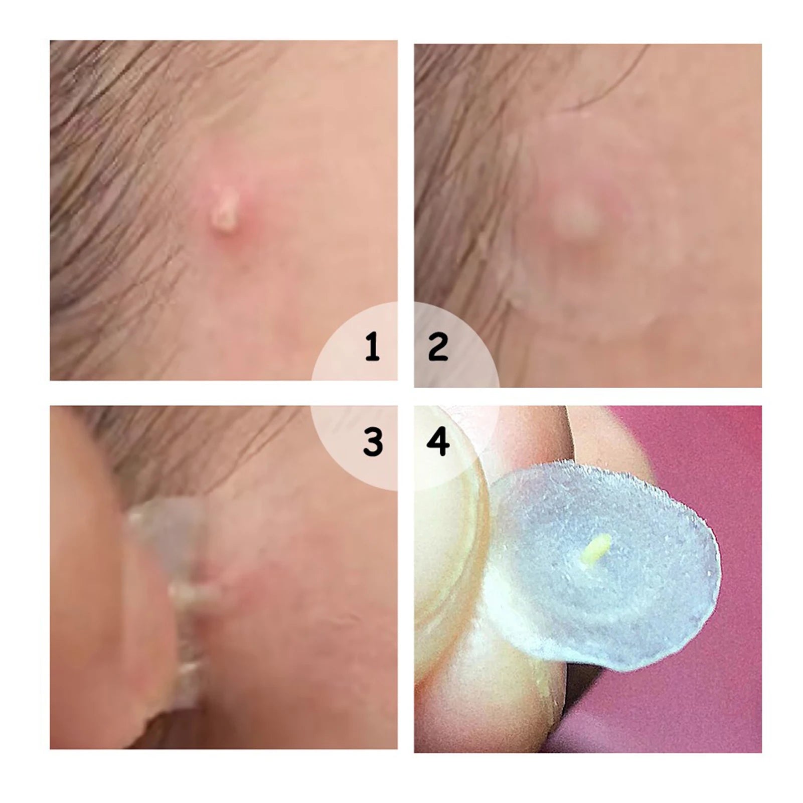 【Hot sales】72Pcs Invisible Removal Pimple Anti-Acne Hydrocolloid Patches Spots Marks Concealer Waterproof Repair Sticker Peaceful Pleasures Health and Wellness