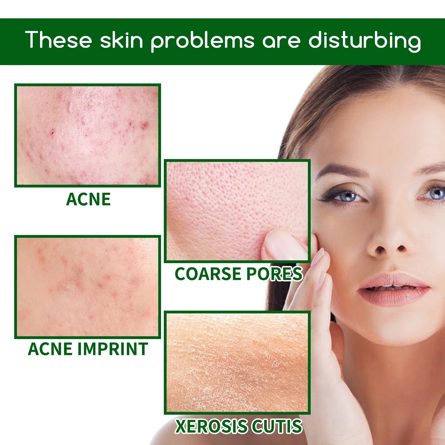 Salicylic Acid Acne Face Serum – Pores, Blackheads & Oil