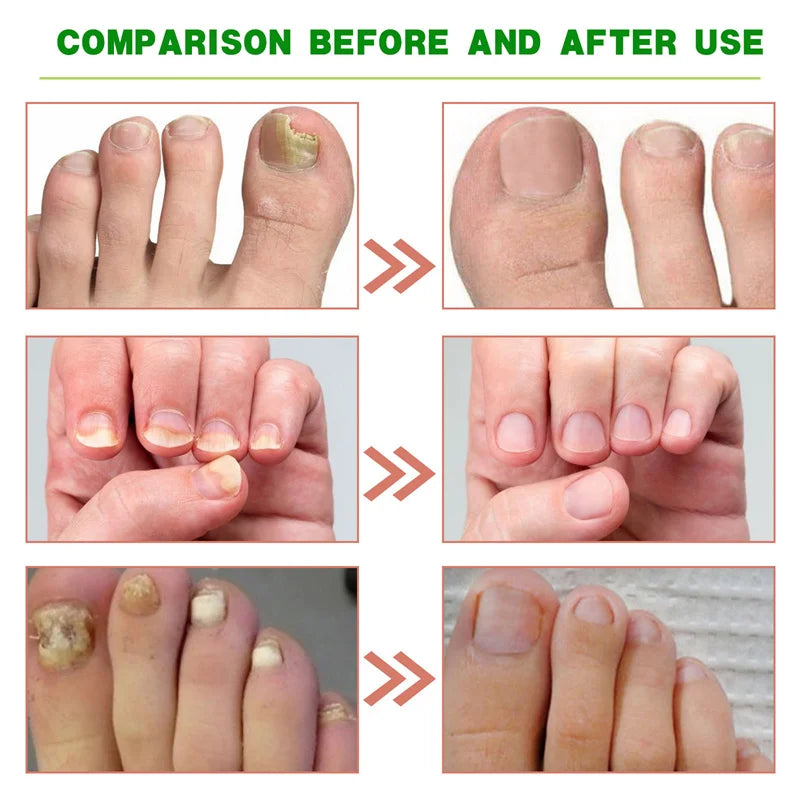 Eelhoe Nail Repair Serum – Ginger Extract for Healthy Nails
