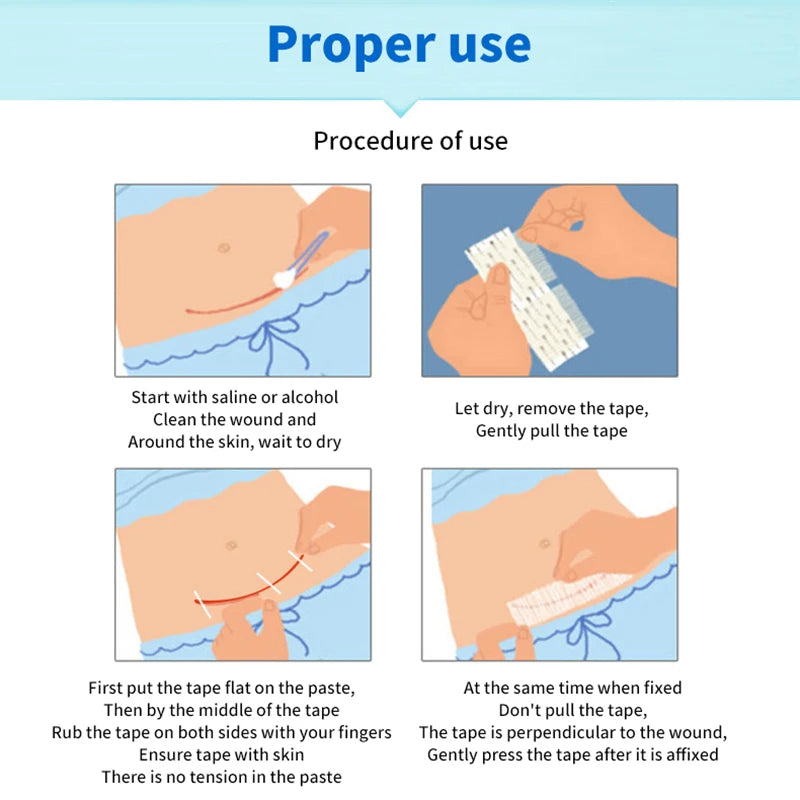 5 Strips Wound Skin Closure Strips Postpartum Wound Repair Cosmetic Surgery Strip Adhesive Medical Suture Free Surgical Tape Peaceful Pleasures Health and Wellness