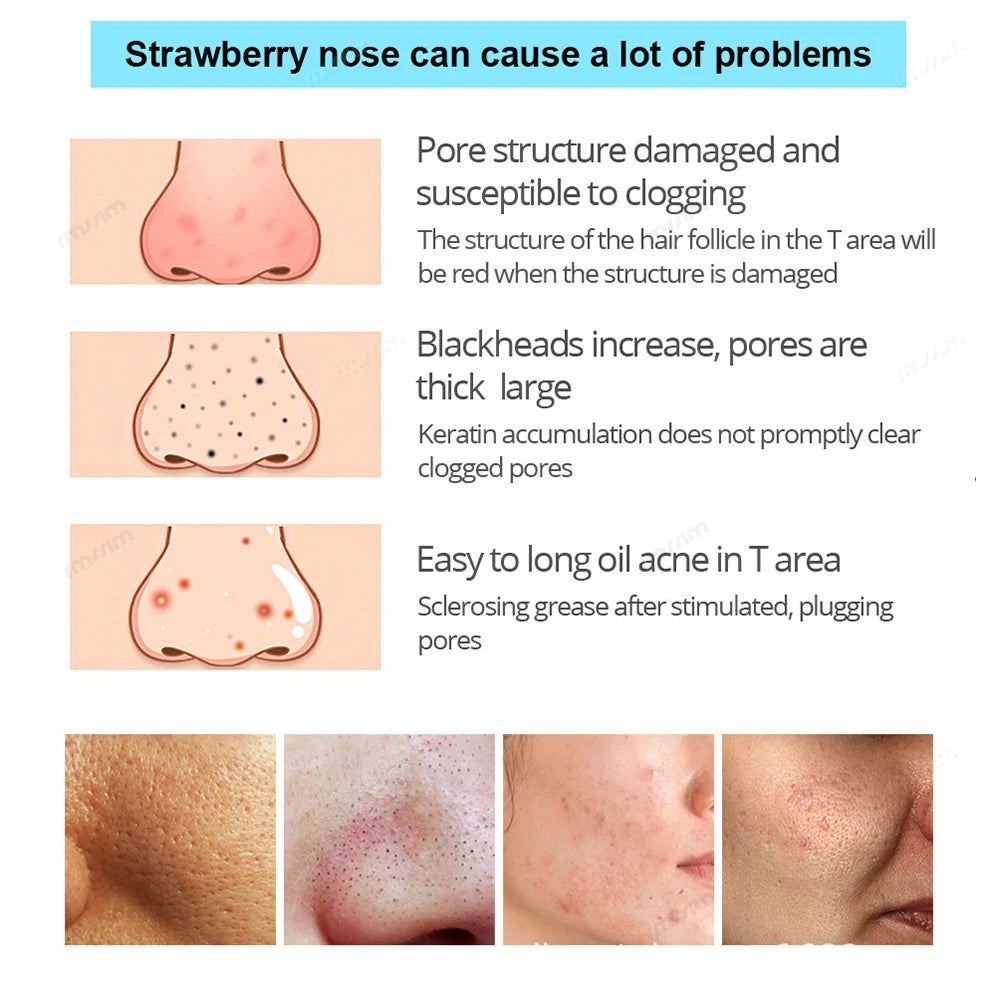 Black Pig Nose Stick Bamboo Charcoal To Remove Blackheads, Remove Acne, Clean Pores, Adsorb Oil And Dirt Nose Film Nose Stick Peaceful Pleasures Health and Wellness
