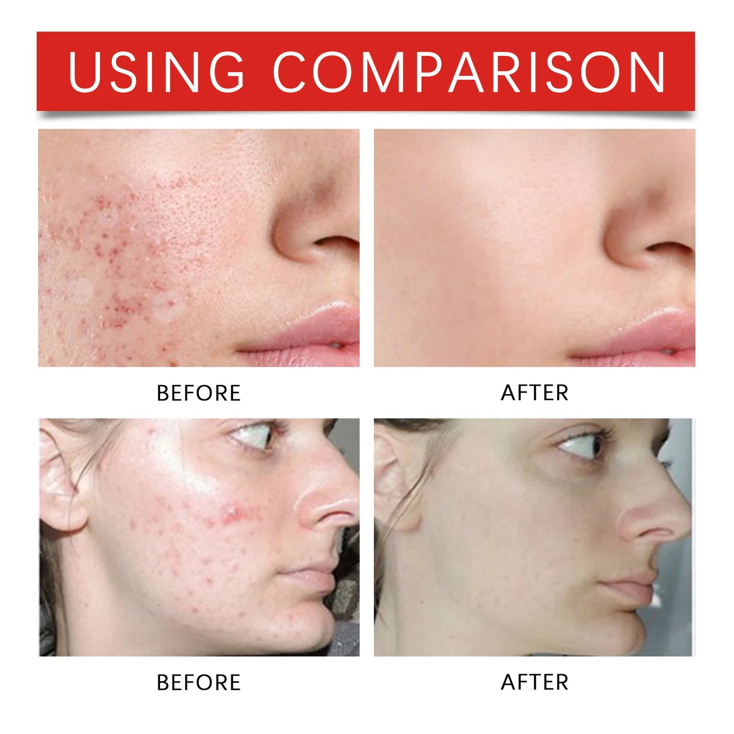 240 Pcs Star & Heart Salicylic Acid Acne Patches | Hydrocolloid
