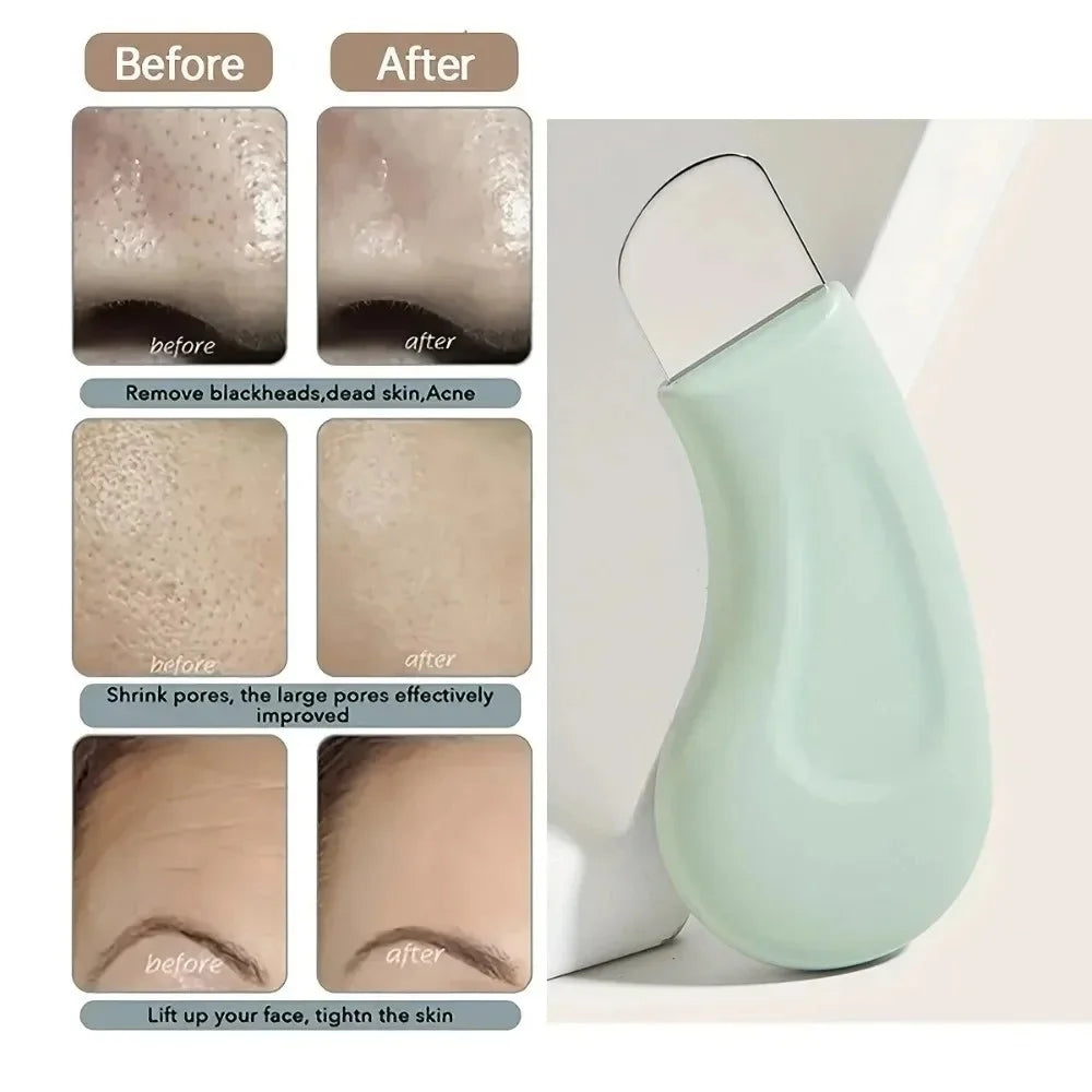Blackhead & Whitehead Removal Tool – Face & Nose Pore Cleaner