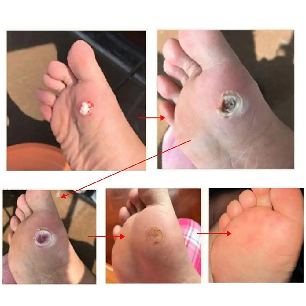 6PCS Corn Remover Plaster, Adhesive Foot Corn Callus Removal Pads for Foot Care Corns Callus Feet Sore Shoes Sticker Self Adhesi Peaceful Pleasures Health and Wellness