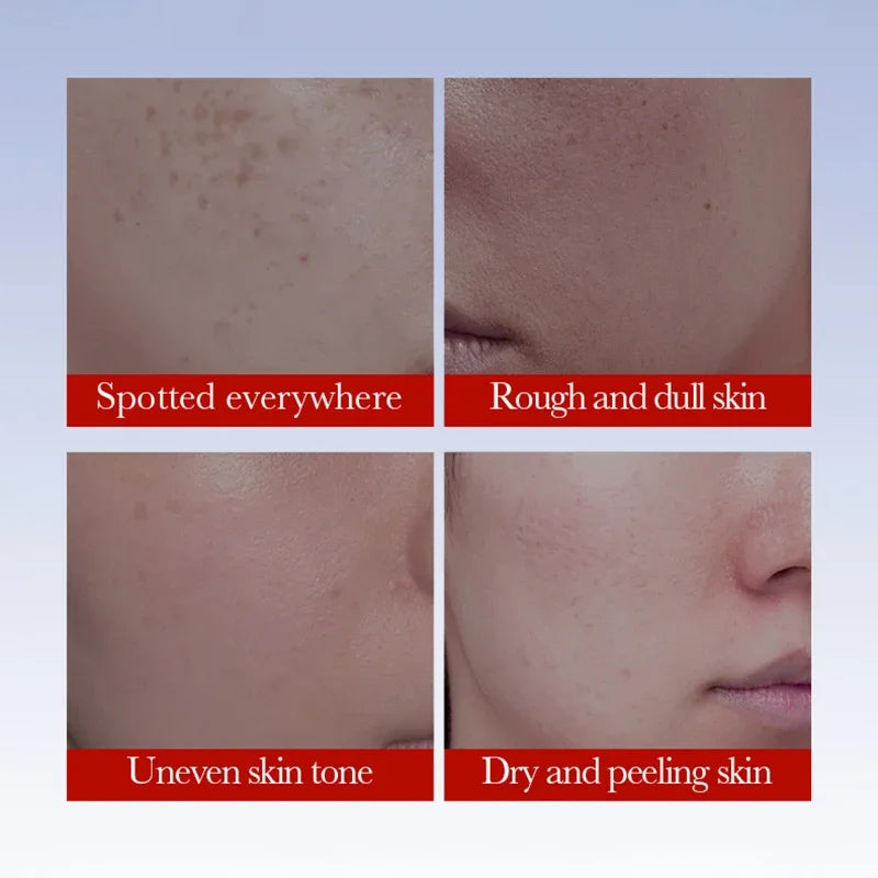SADOER Anti Freckle Cream Face Whitening Creams Spot Removing Anti-aging Moisturizing Freckles Removal Facial Cream Skin Care Peaceful Pleasures Health and Wellness