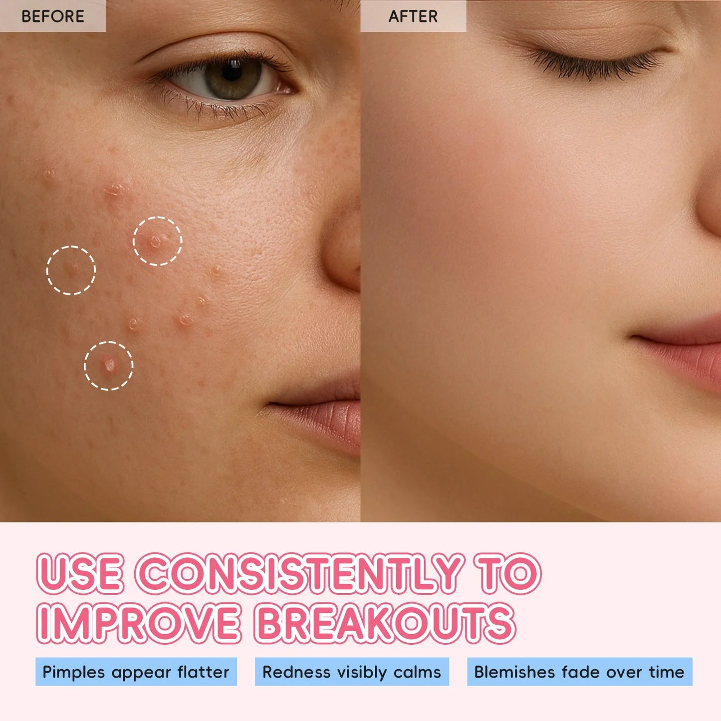 Laikou Sakura Acne Patches – Pimple Concealer Dots 24pcs