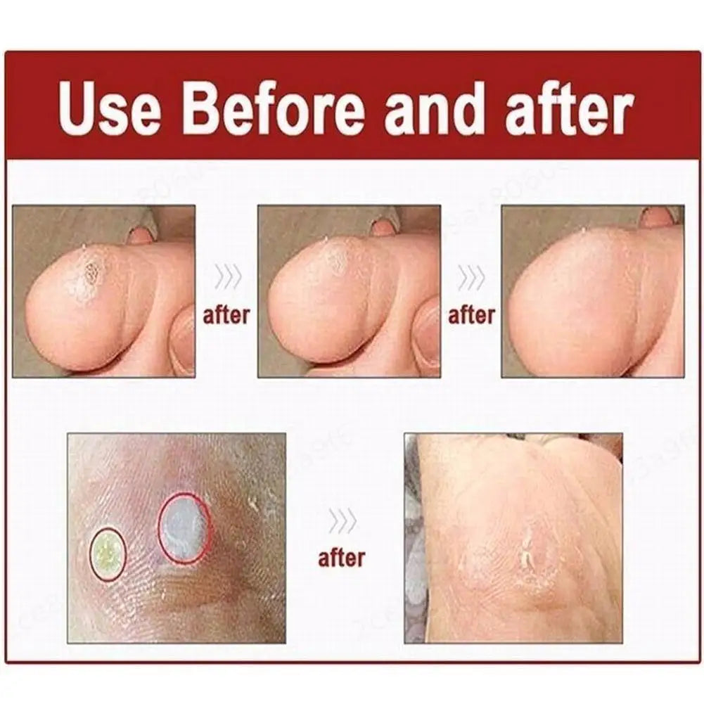6-Pack Corn & Callus Remover Pads – Self-Stick Foot Patches