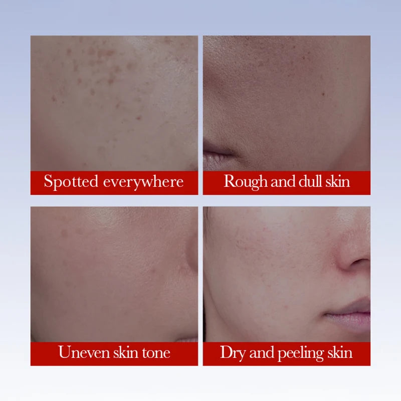 SADOER Anti Freckle Cream Face Brightening Creams Spot Removing Anti-aging Moisturizing Freckles Removal Facial Cream Skin Care Peaceful Pleasures Health and Wellness