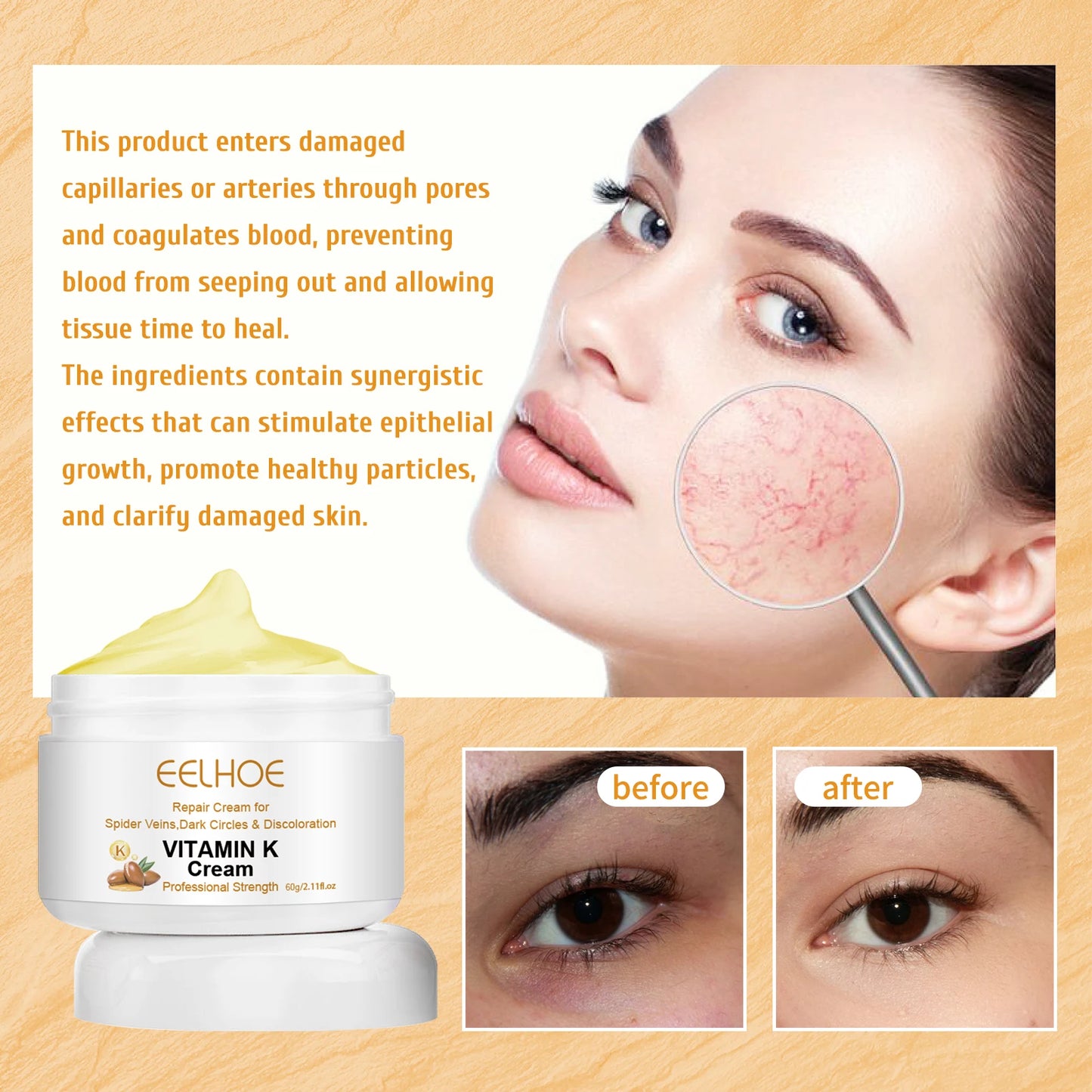 Vitamin K Cream for Varicose Veins, Spider Veins & Leg Relief