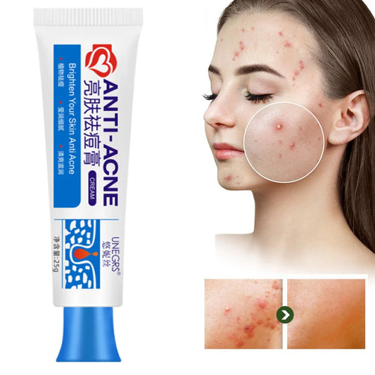 Herbal Acne Face Cream – Pore Minimizing & Skin Brightening Gel Acne Gel Cream Oasis Select