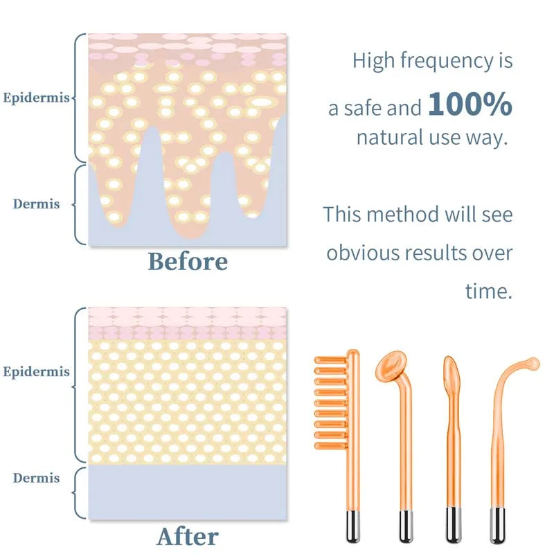Enhanced Version High Frequency Electrotherapy : Pro-Grade Power for Salon-Worthy Skin Tackles Acne, Scars & Fine Lines Peaceful Pleasures Health and Wellness