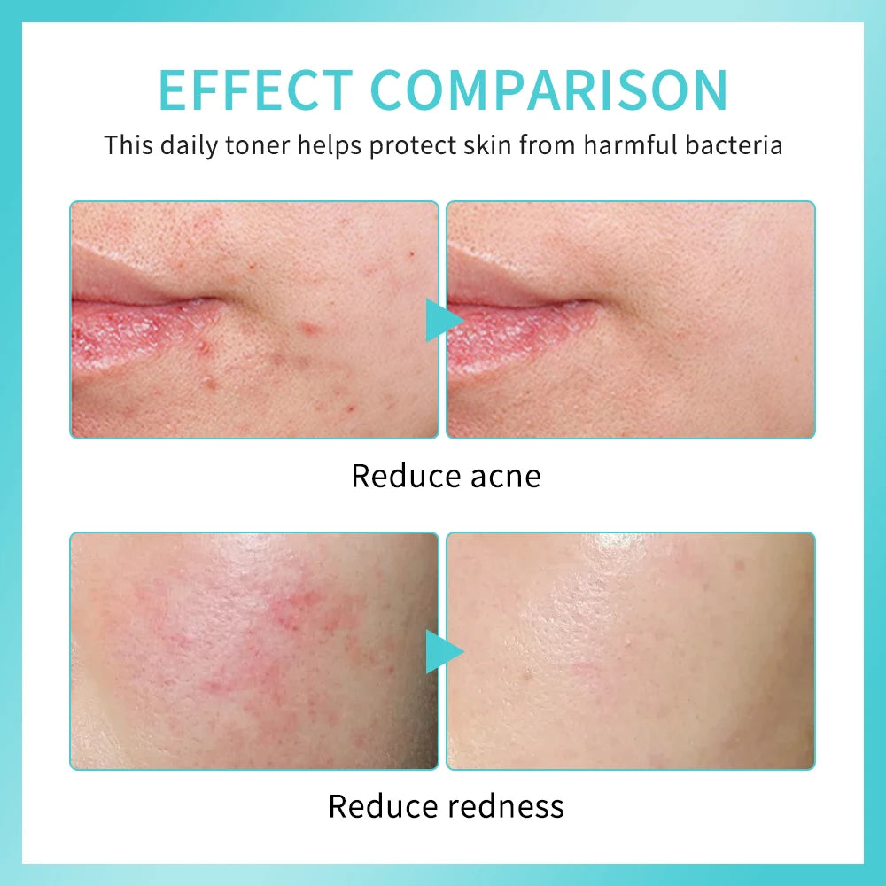 Daily Rescue Facial Spray for Sensitive Skin Hypochlorous Acid Spray Helps Reduce Redness Breakouts Soothing pH Balancing Toner Peaceful Pleasures Health and Wellness