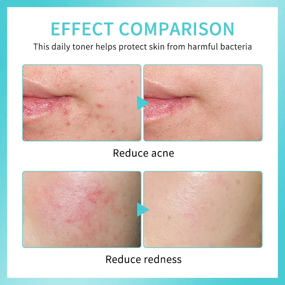 Hypochlorous Acid Facial Toner Spray – pH Balance, 30ml