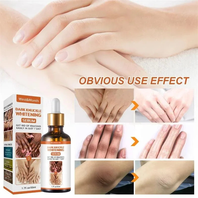 Dark Knuckles Whitening Serum Remover Get Rid of Dark Knees Dark Knuckle Elbow Cream Moisturizing Brighten Skin Tone Care Peaceful Pleasures Health and Wellness