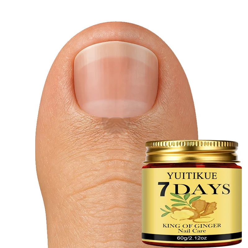 YUITIKUE Ginger King Nail Cream – 7-Day Nail Care, 60g Nail Treatment Cream Peaceful Pleasures Health and Wellness