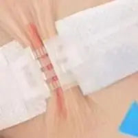 Zipper Wound Closure Strips | No-Suture Fast Closure Patch Wound Closure Strip Oasis Select