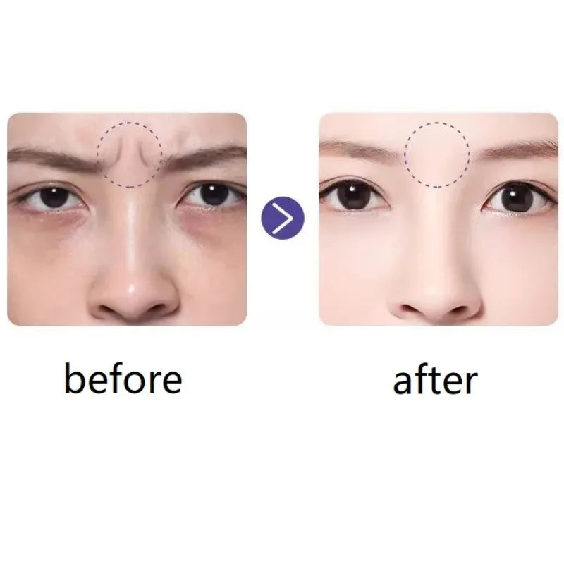 Reusable Anti-Wrinkle Face Patches – Forehead & Frown Lines