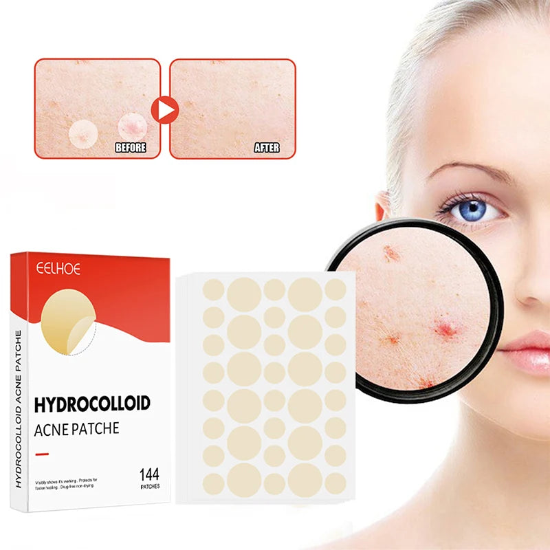 144-Piece Hydrocolloid Acne Pimple Patches – 2 Sizes, Invisible