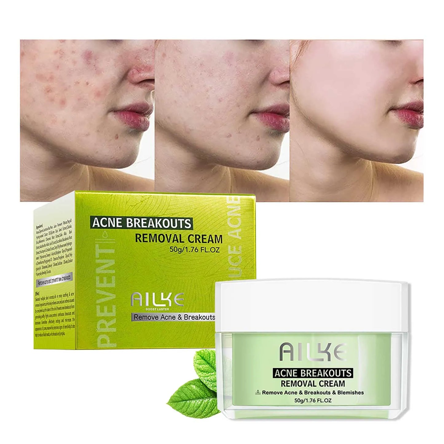 AILKE Acne Face Cream – Clear Skin, All Types | 50ml