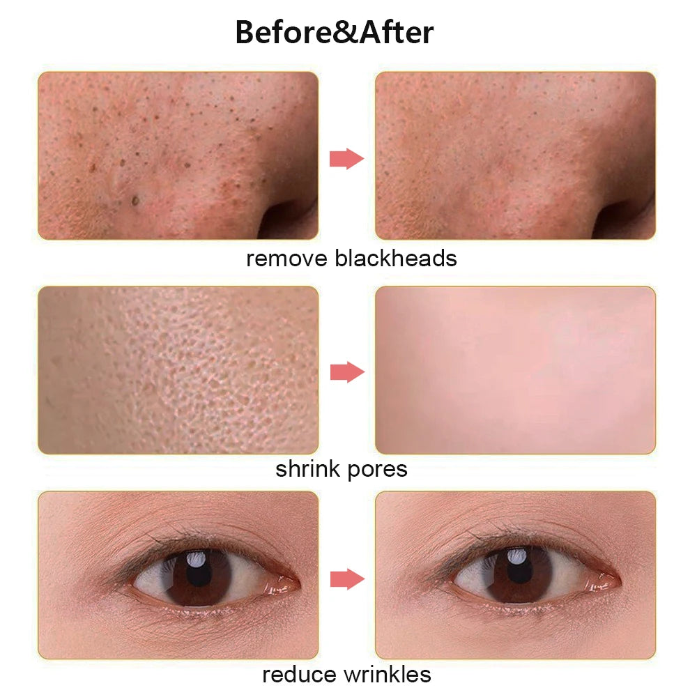 Ultrasonic Skin Scrubber Blackhead Remover Ultrasonic Peeling Pore Cleaner Face Cleaning Scrubber Ultrasonic Facial Espatula Peaceful Pleasures Health and Wellness