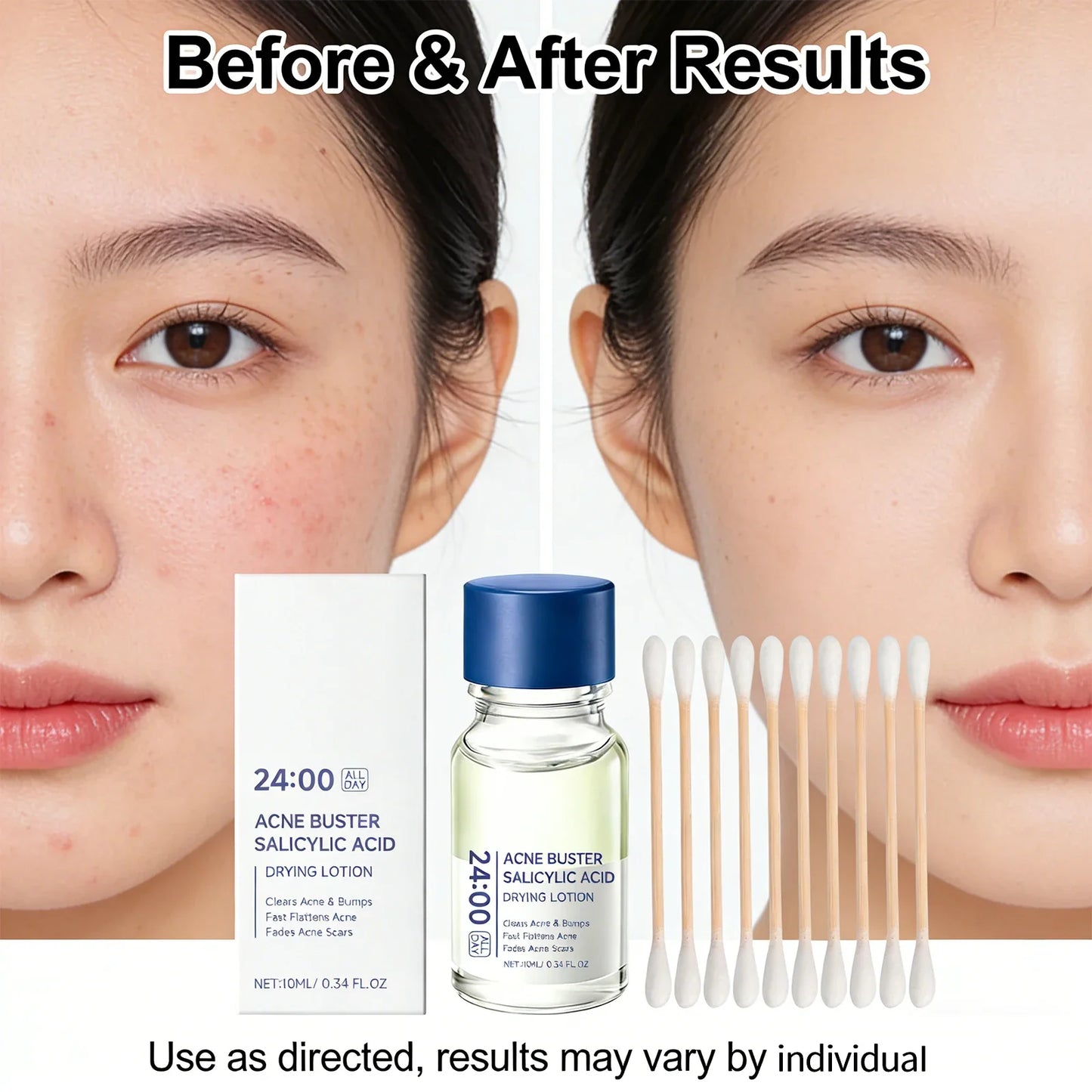 Salicylic Acid Drying Lotion Serum – Clear Pores & Fade Marks