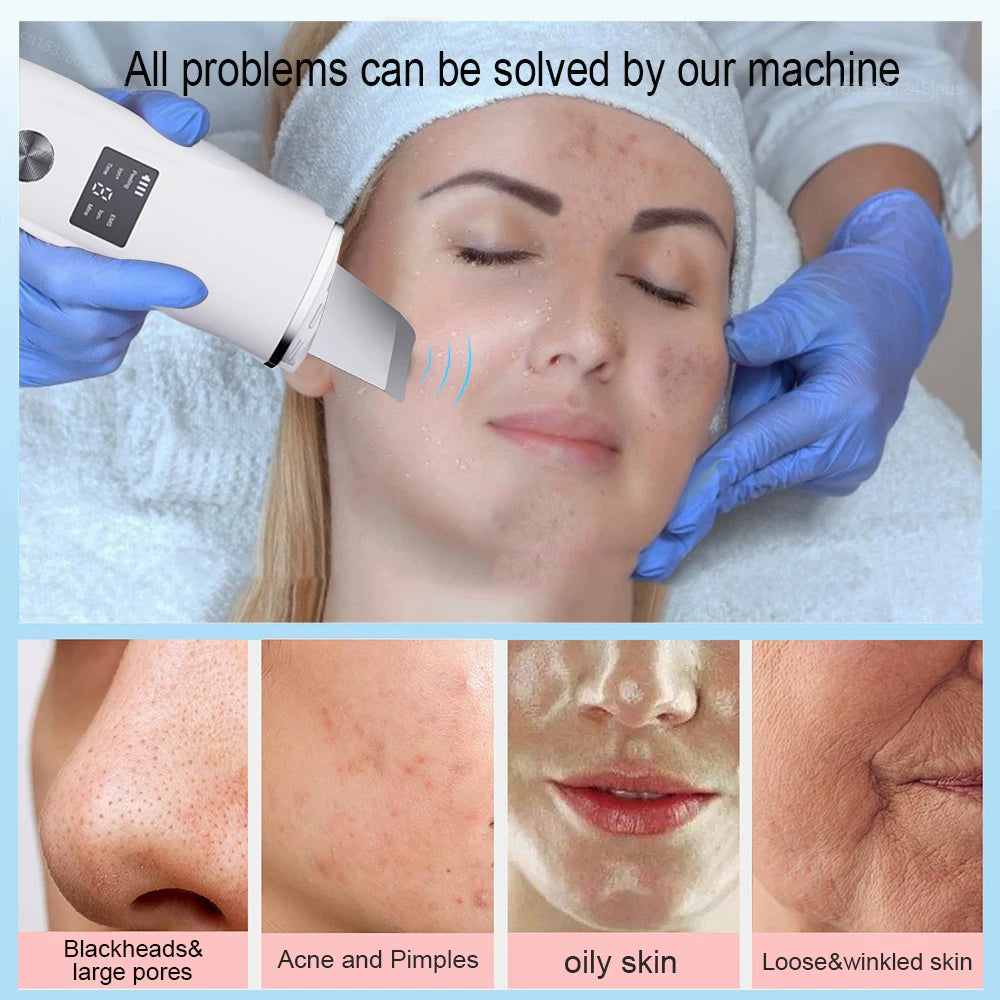 Ultrasonic Face Scrubber Facial Peeling Skin Scrubber Deep Facial Cleaning Spatula Acne Pore Ultrasonic Scrubber Facial Cleanser Peaceful Pleasures Health and Wellness