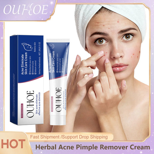 Herbal Acne Face Cream – Oil Control & Blemish Care 20g Acne Face Cream Peaceful Pleasures Health and Wellness