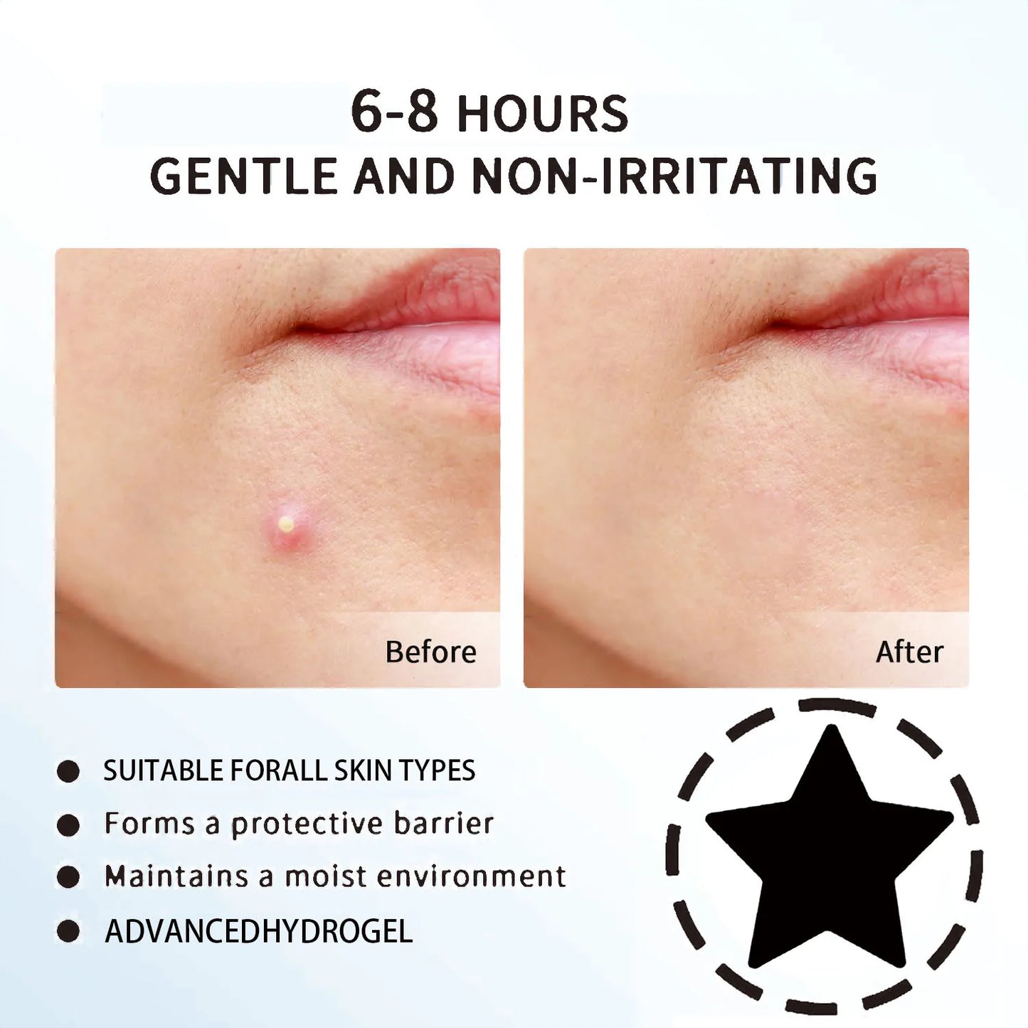 Invisible Waterproof Hydrocolloid Acne Patches – All Skin Types