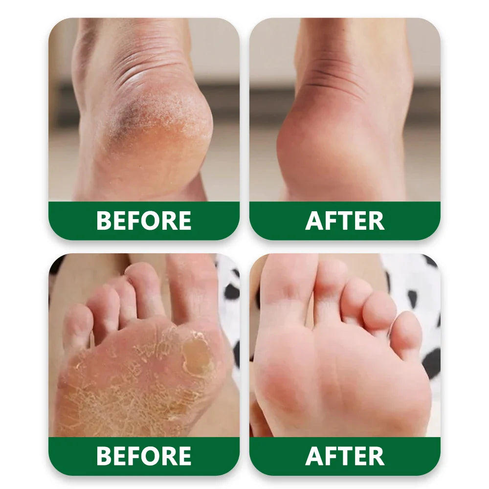 Tea Tree Oil Foot Cream – Dry Cracked Heels & Callus Balm