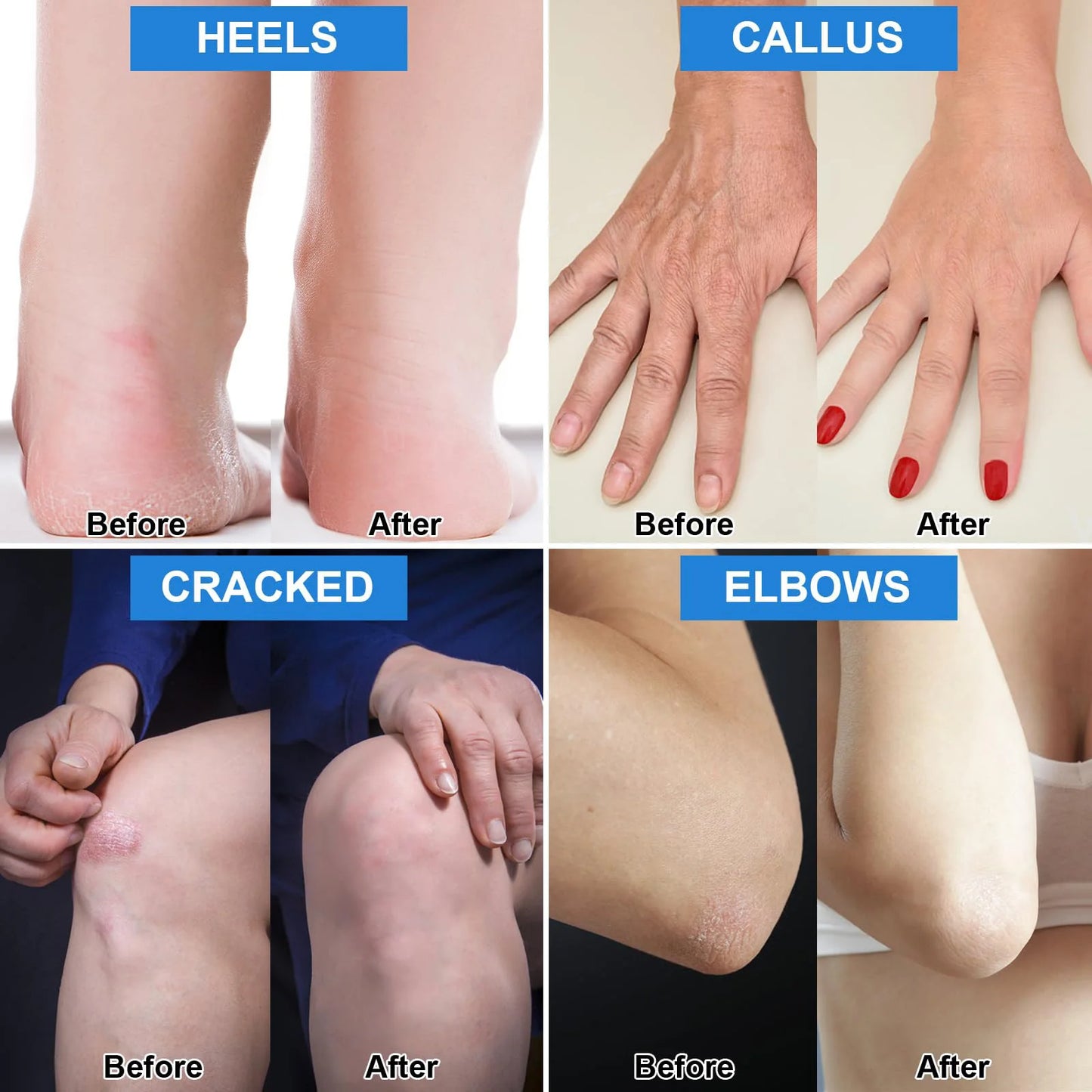 Urea Cream 42% Plus Salicylic Acid 2%, Lavender Foot Cream for Dry Cracked Heels Treatment Knees Elbows Hands Repair Treatment, Peaceful Pleasures Health and Wellness