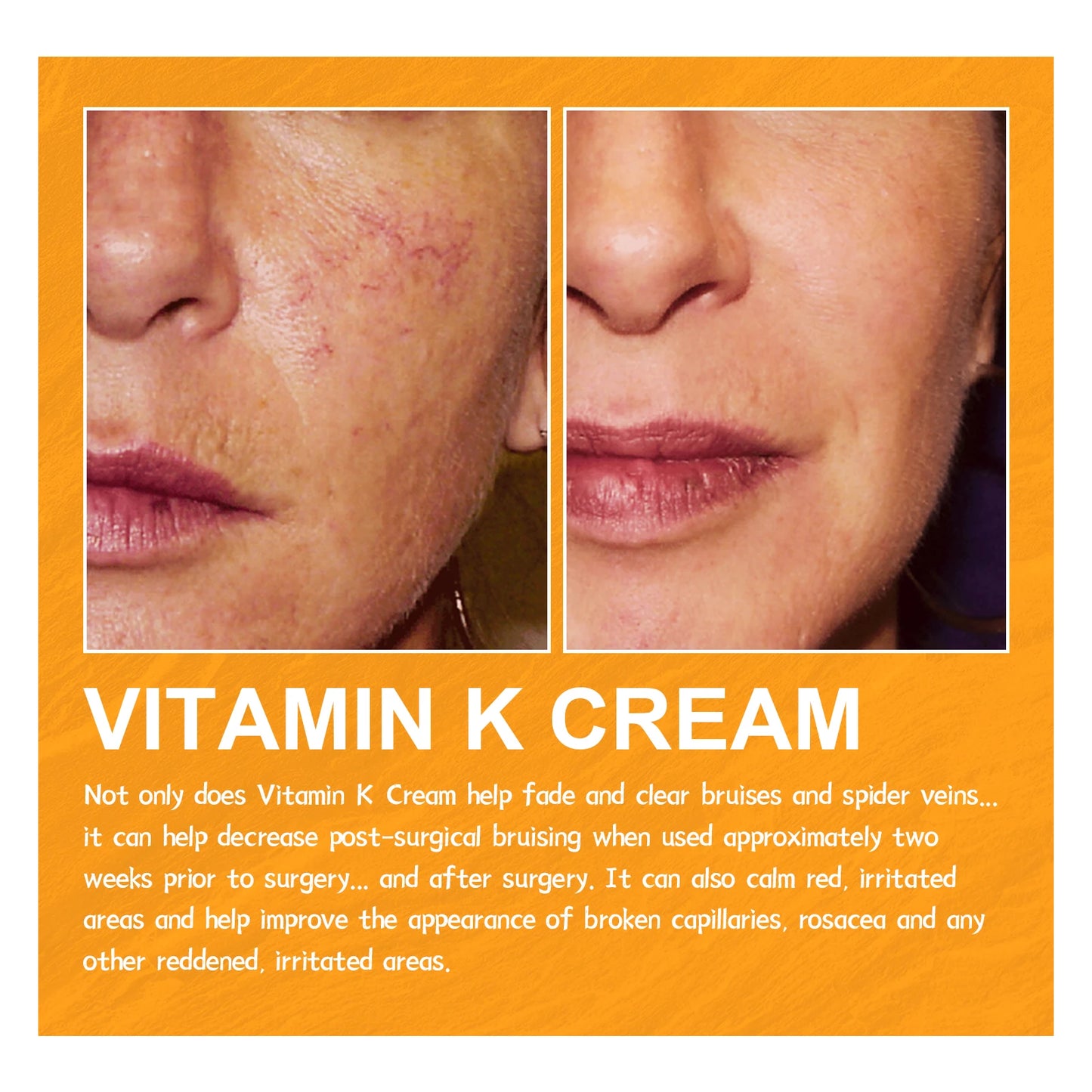 Vitamin K Cream for Varicose Veins, Spider Veins & Leg Relief