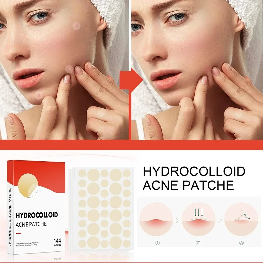 Hydrocolloid Acne Patches – 144pc Invisible Pimple Cover Peaceful Pleasures Health and Wellness