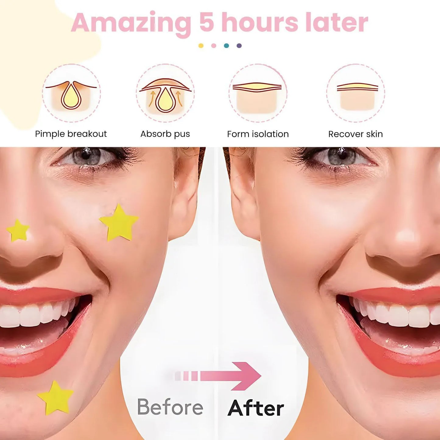 Invisible Waterproof Hydrocolloid Acne Patches – All Skin Types