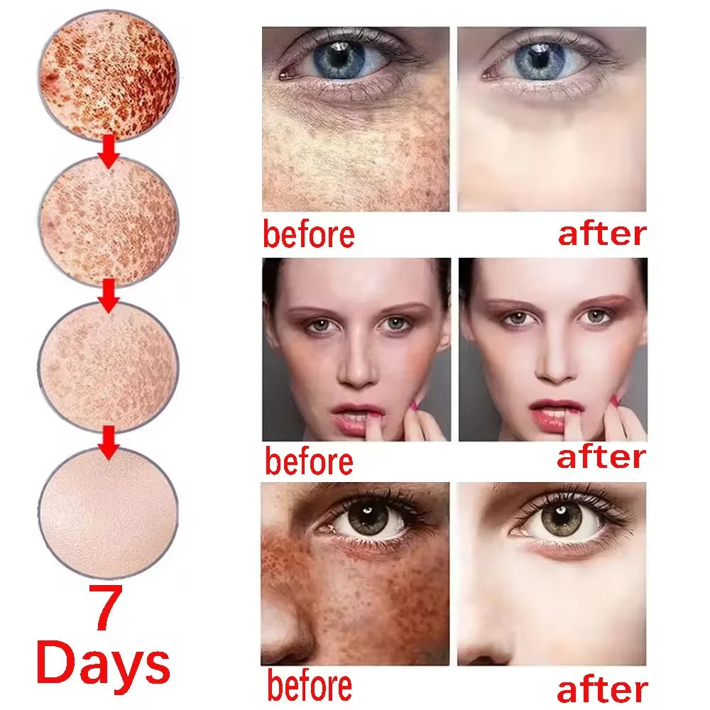 Effective Whitening Freckles Face Cream Removal Melasma Dark Spots Fade Melanin Pigmentation Corrector Brighten Repair Skin Care Peaceful Pleasures Health and Wellness