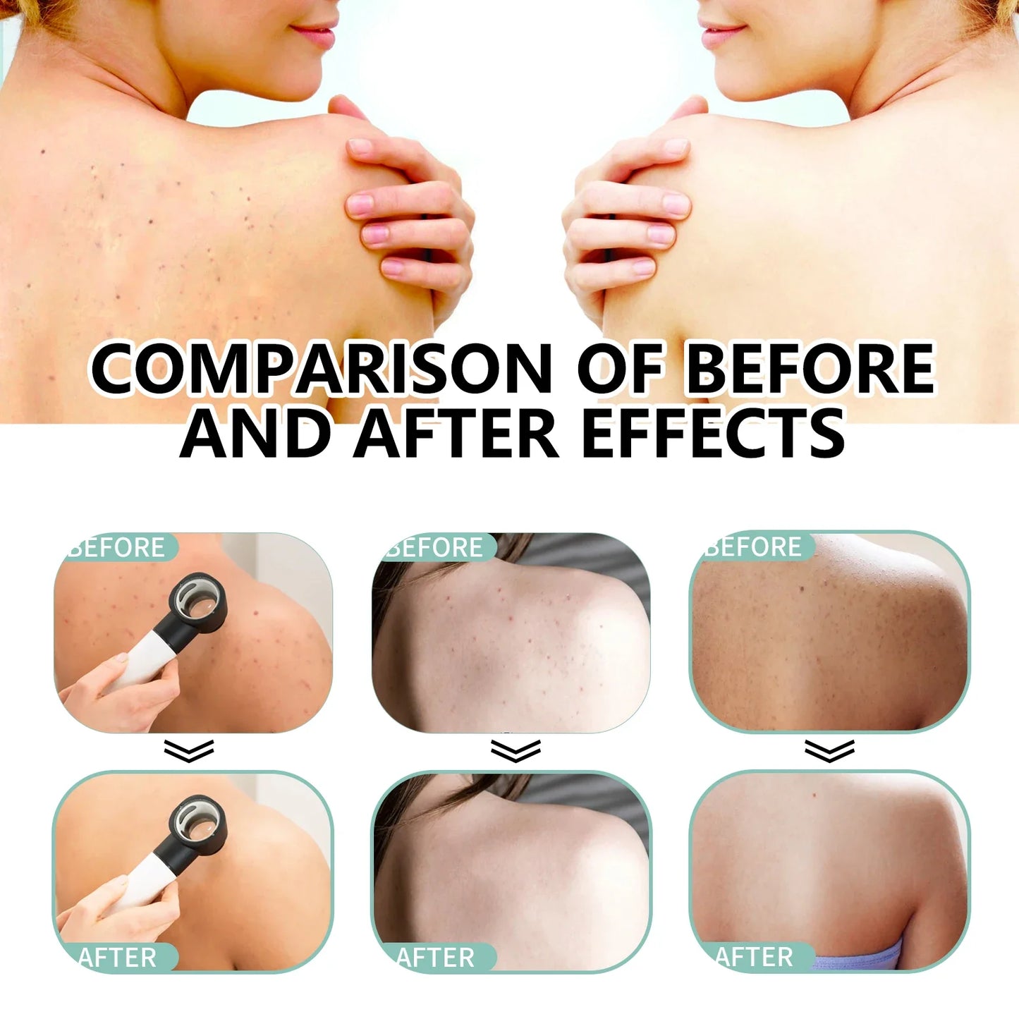 OceAura Herbal Acne Spray – Back, Shoulder & Pore Treatment