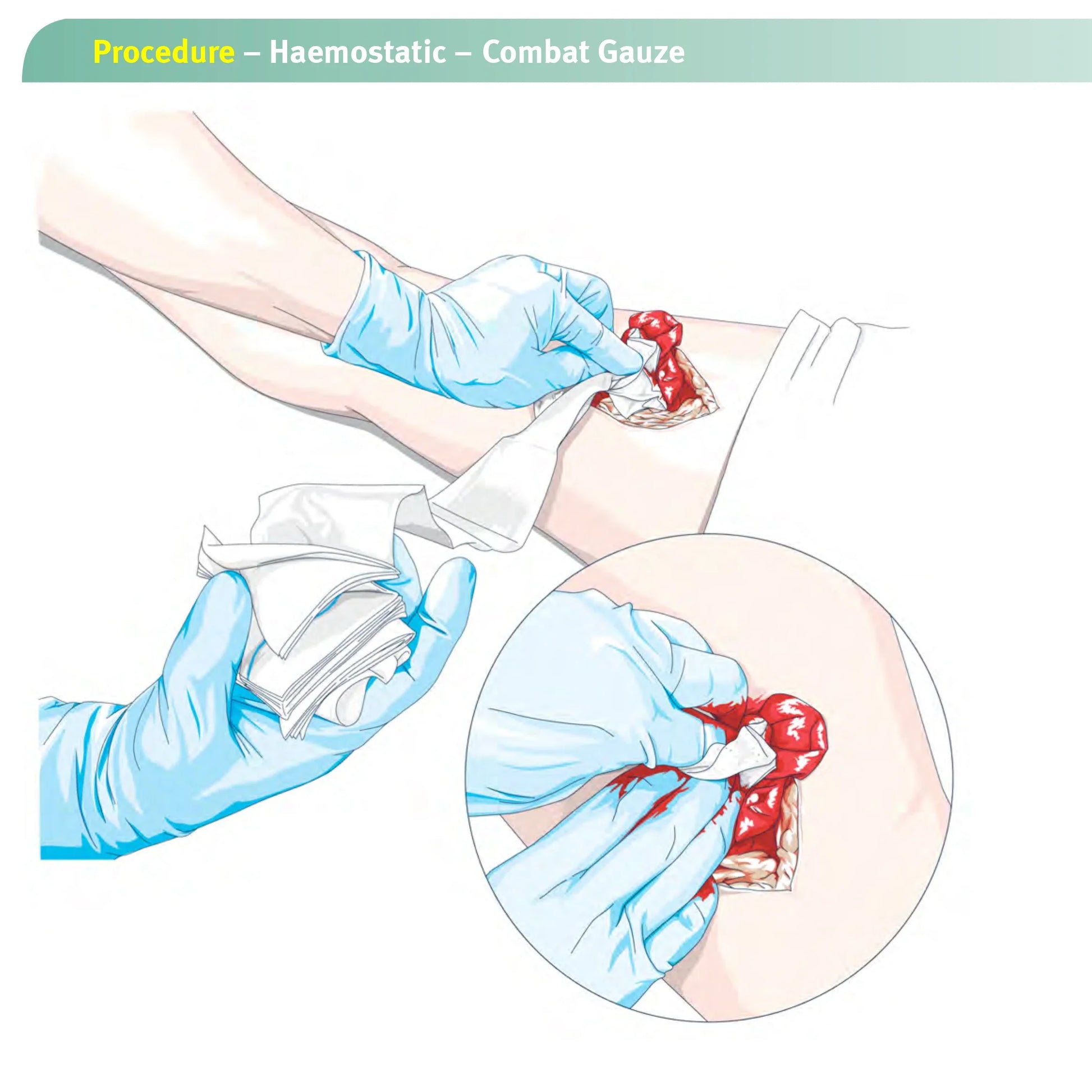 1.5/3.75M Hemostatic Kaolin Gauze Combat Emergency Trauma Z-Fold Soluble For Ifak Tactical First Aid Kit Medical Wound Dressing Peaceful Pleasures Health and Wellness